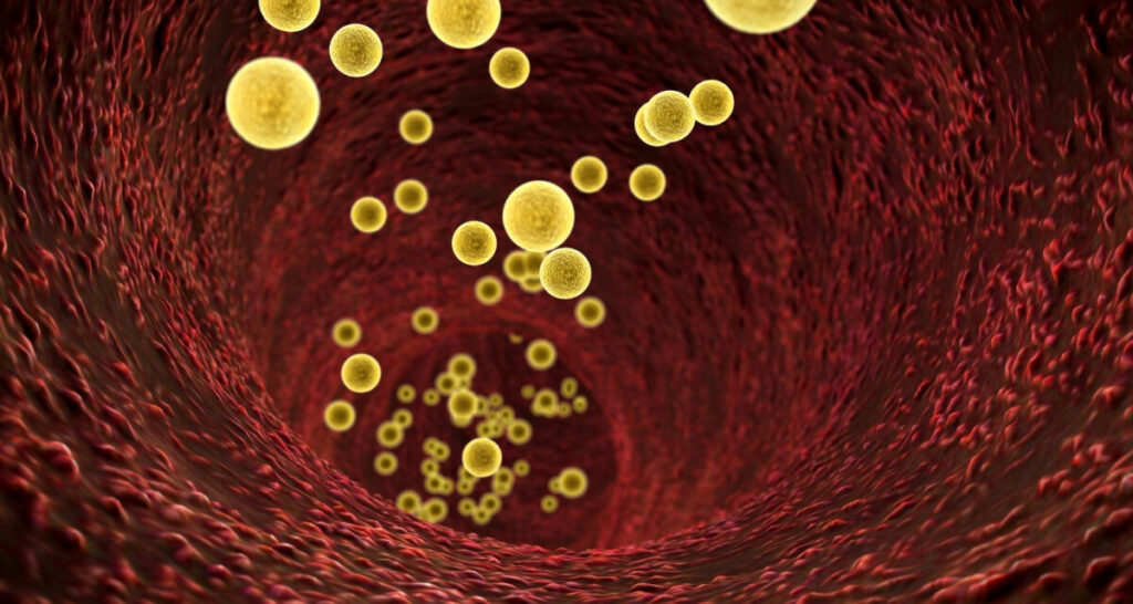 Wat zijn de symptomen van een hoge cholesterol?